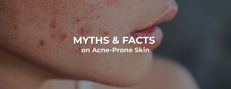 Myths & Facts on Acne-Prone Skin